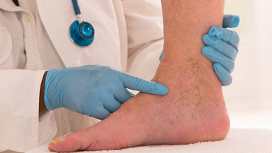 Photo of Best and Safe Remedies to Get Rid of Spider Veins