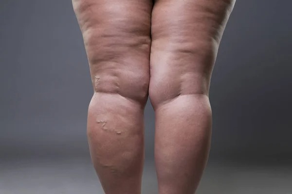 Photo of A PROMISING SOLUTION FOR LIPEDEMA PATIENTS SEEKING EFFECTIVE TREATMENT