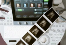Photo of Coronary calcium scan benefit may be limited to borderline-risk patients, 10-year study finds