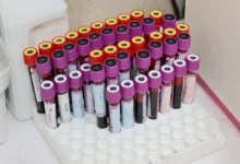Photo of Early-onset cancer biological aging link found across 160,000 adults in new study