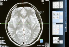 Photo of Long COVID dopamine neurons show damage in PET imaging study