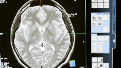 Photo of Long COVID dopamine neurons show damage in PET imaging study