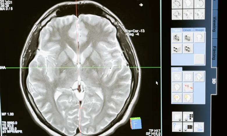 long COVID dopamine neurons
