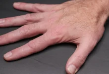 Photo of GLP-1 nail detachment study finds fourfold rise in users at EADV 2026